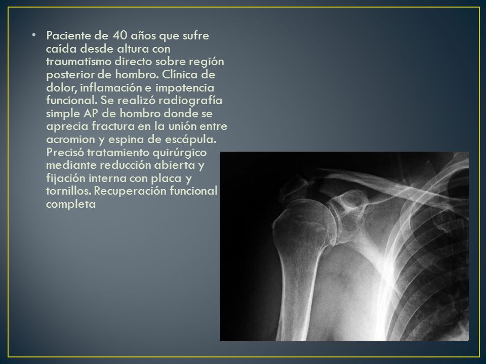 Fractura de costilla tratamiento quirurgico